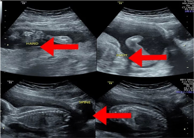 在超声图上,胎儿可能呈现灰色或白色,位于羊水中(子宫内的暗色区域.