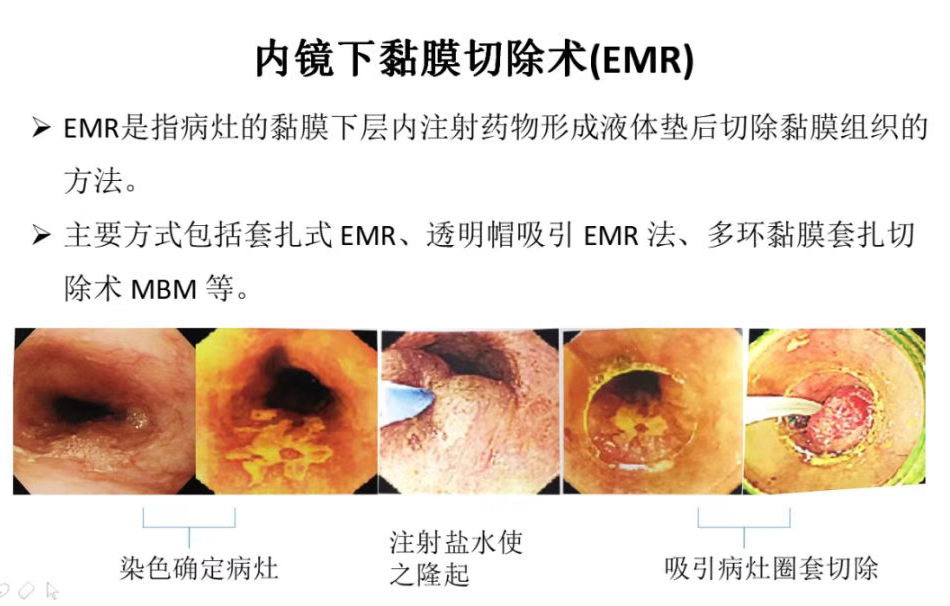 积极治疗食管疾病,及时处理癌前病变,如食管炎,食管息