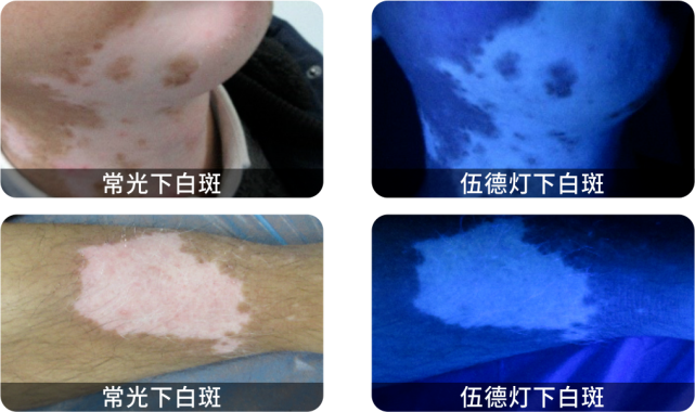 白癜风确诊利器——伍德灯,有效避免漏诊误诊