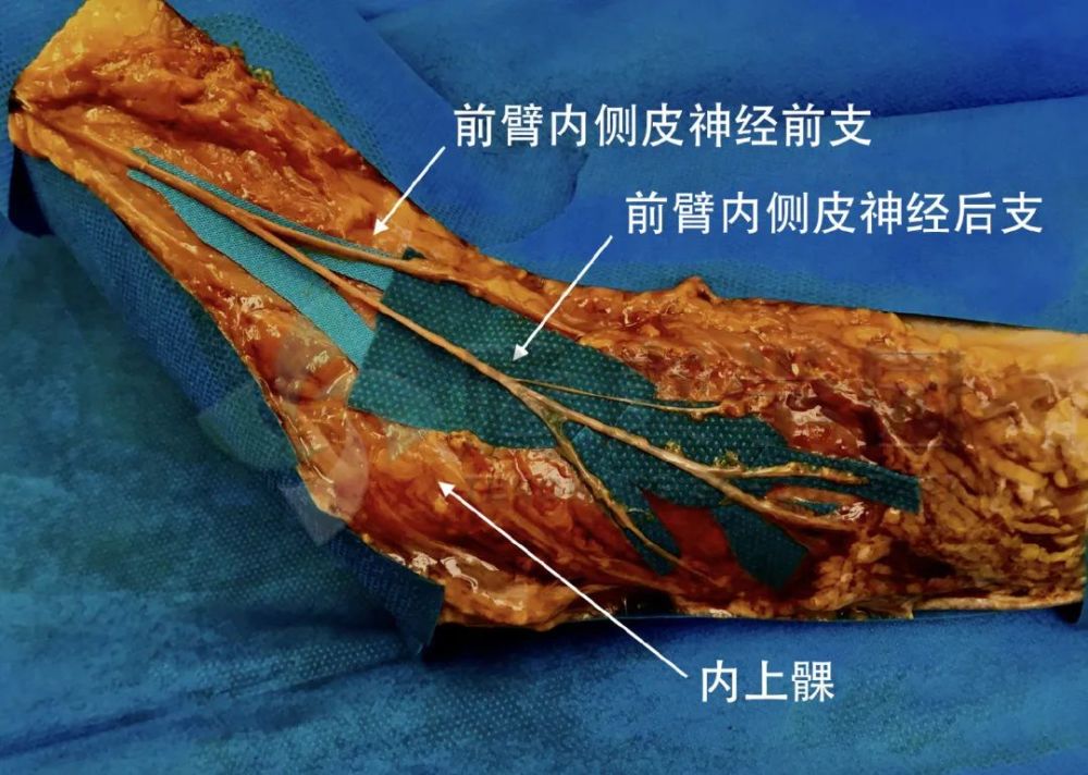 前臂内侧疼痛的神经