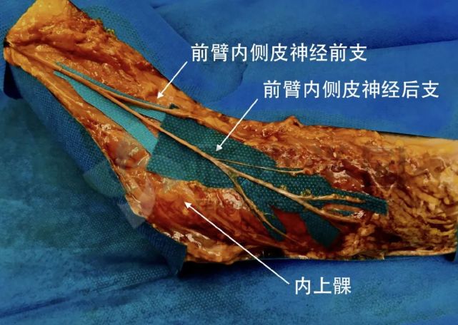 前臂内侧皮神经的前支和后支通常出现在内上髁和外上髁水平.