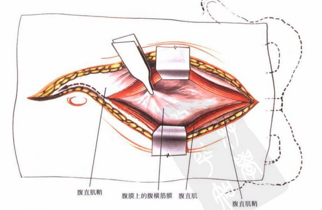 图4 术者以手指分开中线处的腹直肌显露股膜.