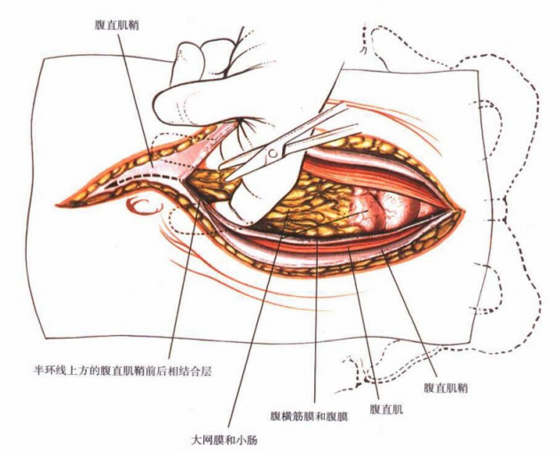 图4 术者以手指分开中线处的腹直肌显露股膜.