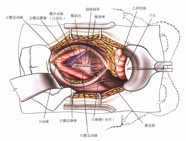 图8 牵开后腹膜,显露主动脉分叉和腔静脉,结扎骶正中静脉.