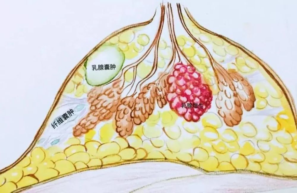 且不能做放射状切口的病损状态,手术过程中可能会切断多根乳腺导管