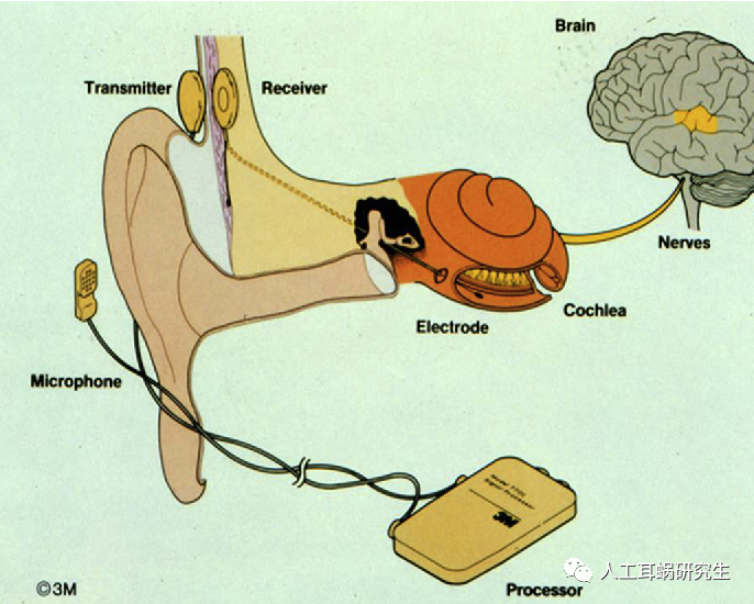 人工耳蜗的前世今生