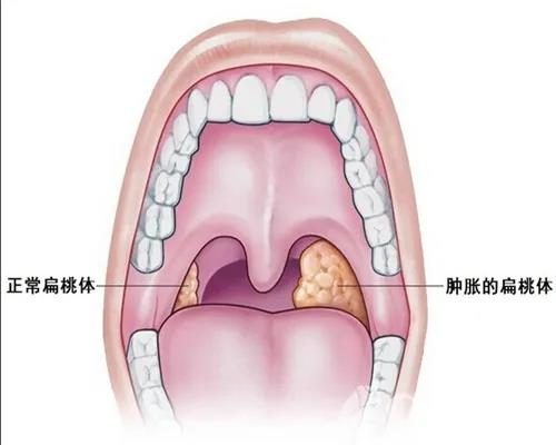 关于扁桃体你知道多少?