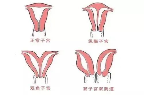 美亚科普|子宫性不孕到底有几种?答案全在这!