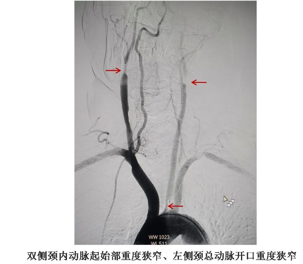 行"主动脉弓 全脑动脉造影,结果提示"右侧颈内动脉起始部重度狭窄