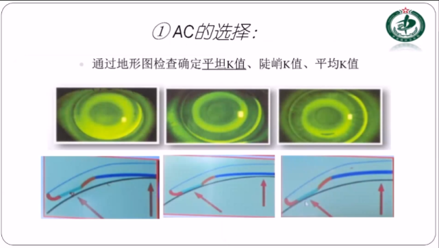 高效验配普诺瞳全弧段非球面角膜塑形镜的小技巧—常枫博士