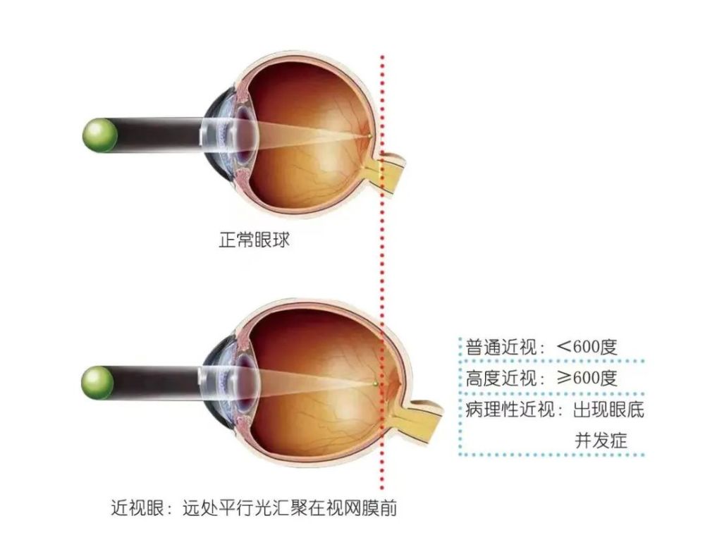 近视1年涨了200度这个行为家长后悔不已