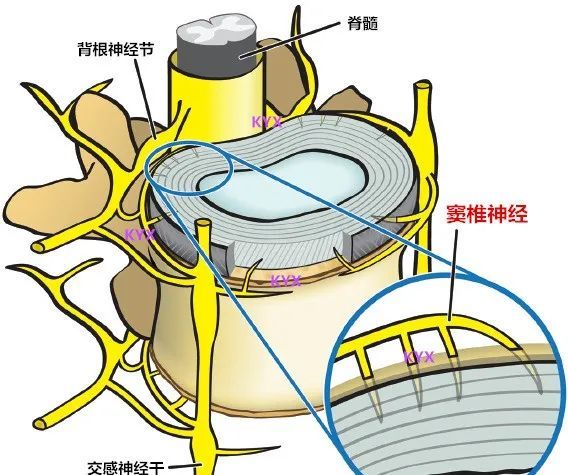 不论是压力,还是张力,都会刺激引发纤维环周边的窦椎神经,从而造成椎