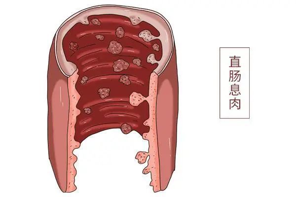 乌鲁木齐远大肛肠医院肛门长肉球是什么原因引起的