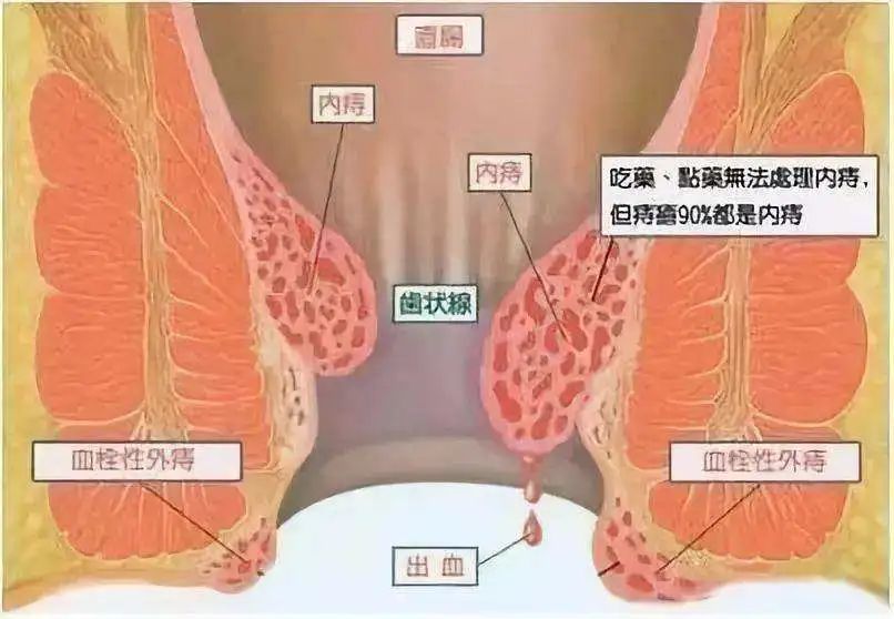 痔疮越长越多肛门长了一圈肉球是怎么回事