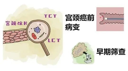 所以想尽早发现宫颈癌,以及宫颈的癌前病变.不正常出血等症状.