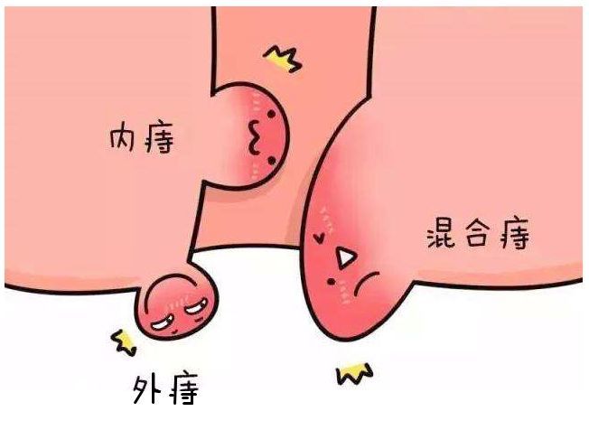 痔疮看似是小问题,如果"痔之不理",就会成为一个"致命"疾病!