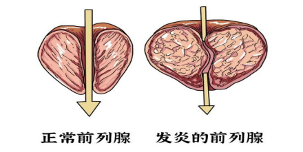 前列腺疼痛综合征