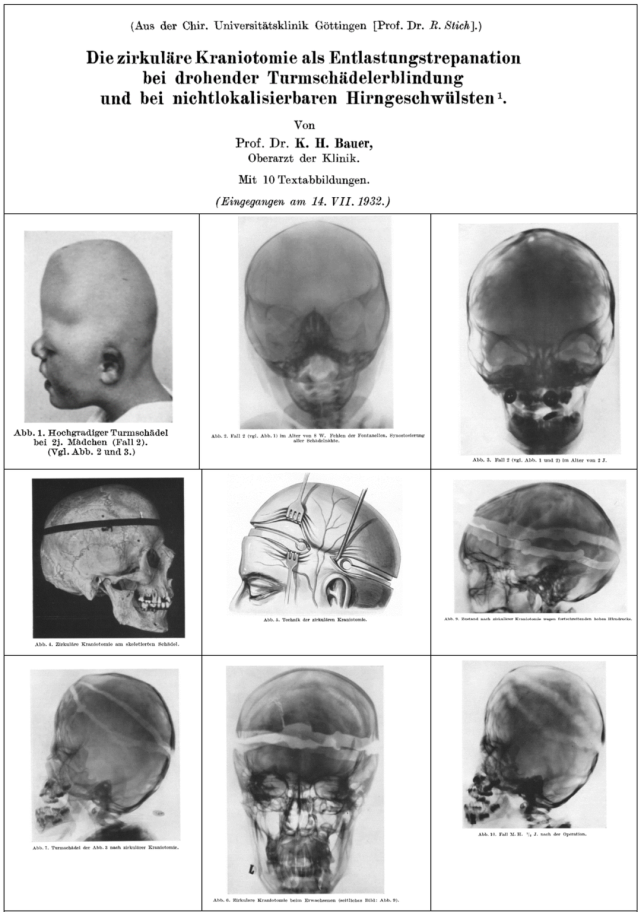 环形开颅术(circular craniotomy)的上演及落幕-大骨瓣减压术系列(五)