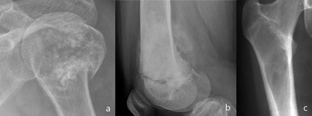 一文全解析:多发性溶骨性病变