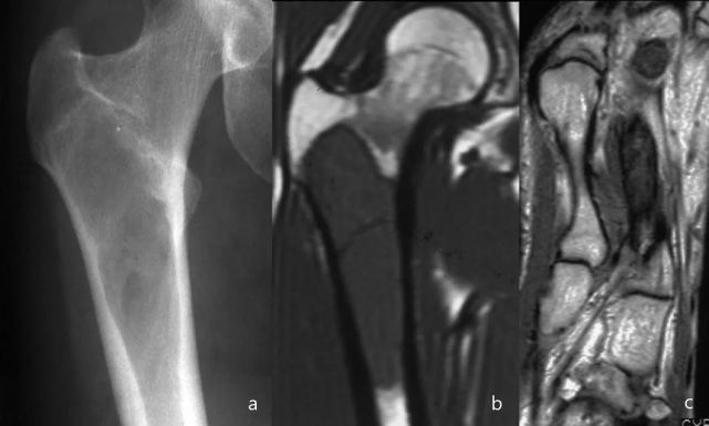 一文全解析:多发性溶骨性病变