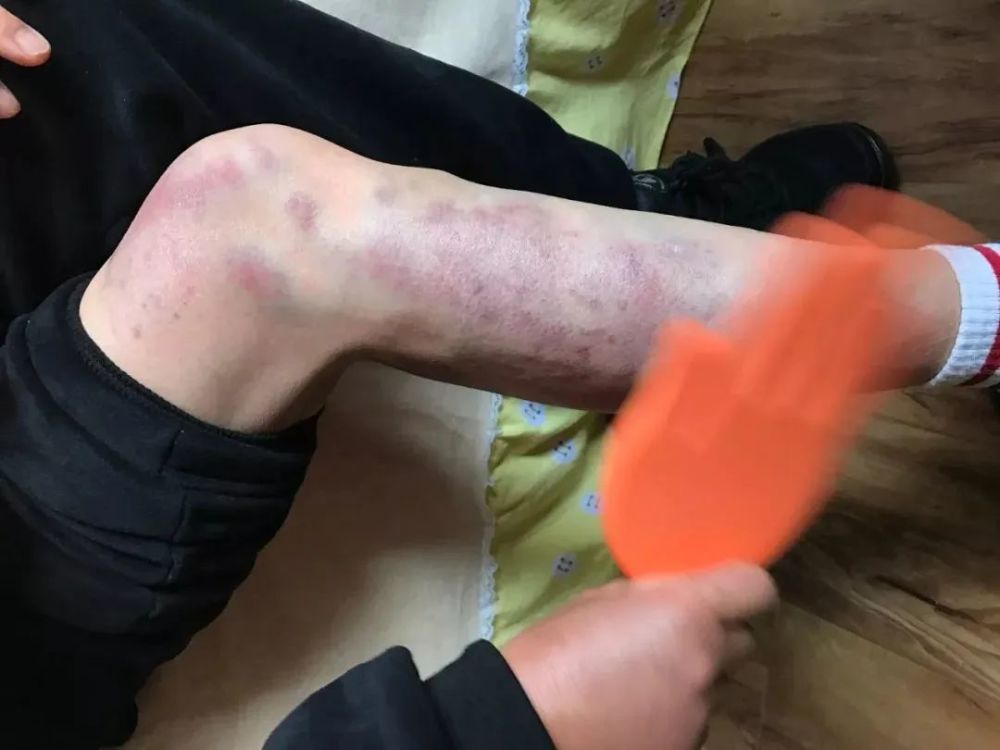 每次拍打某部位完毕再把拍痧掌挪到下一个部位;2,拍透,就是拍打出痧到