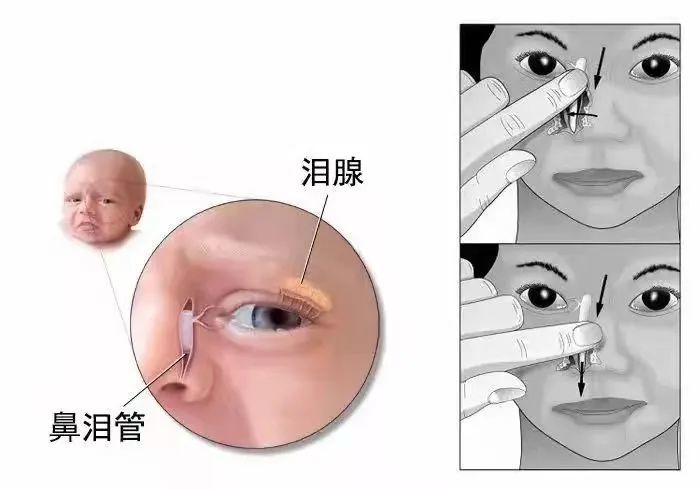 判断有无阻塞及阻塞部位,大多数患儿可随着鼻泪管开口发育开通而自愈