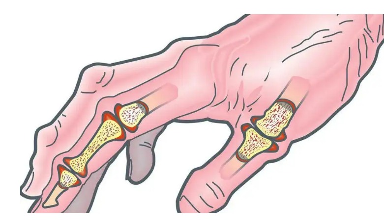 风湿病十问十答一文给你讲清楚