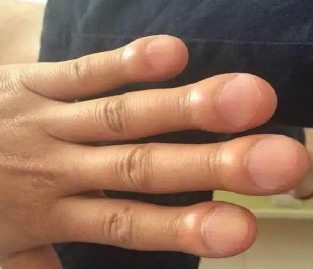 手指变粗查出肺癌?身体4处莫名其妙变大,可能是疾病或癌的预警
