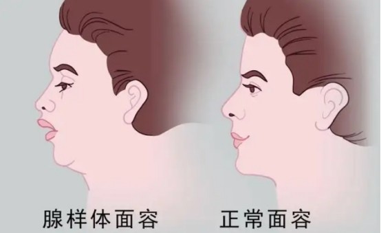 孩子鼻塞,流鼻涕要注意,腺样体肥大不可忽视