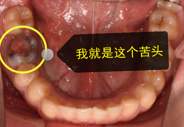 牙洞"里还长了一颗红色的肉球他的大牙不仅烂了一个大洞直到最近妈妈