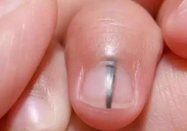 孩子指甲这4种表现是患病信号!第1种可能预示肿瘤