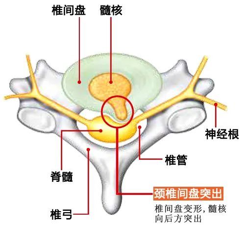 颈肩脖子痛注意椎间盘突出的可能2个动作测出颈椎健康