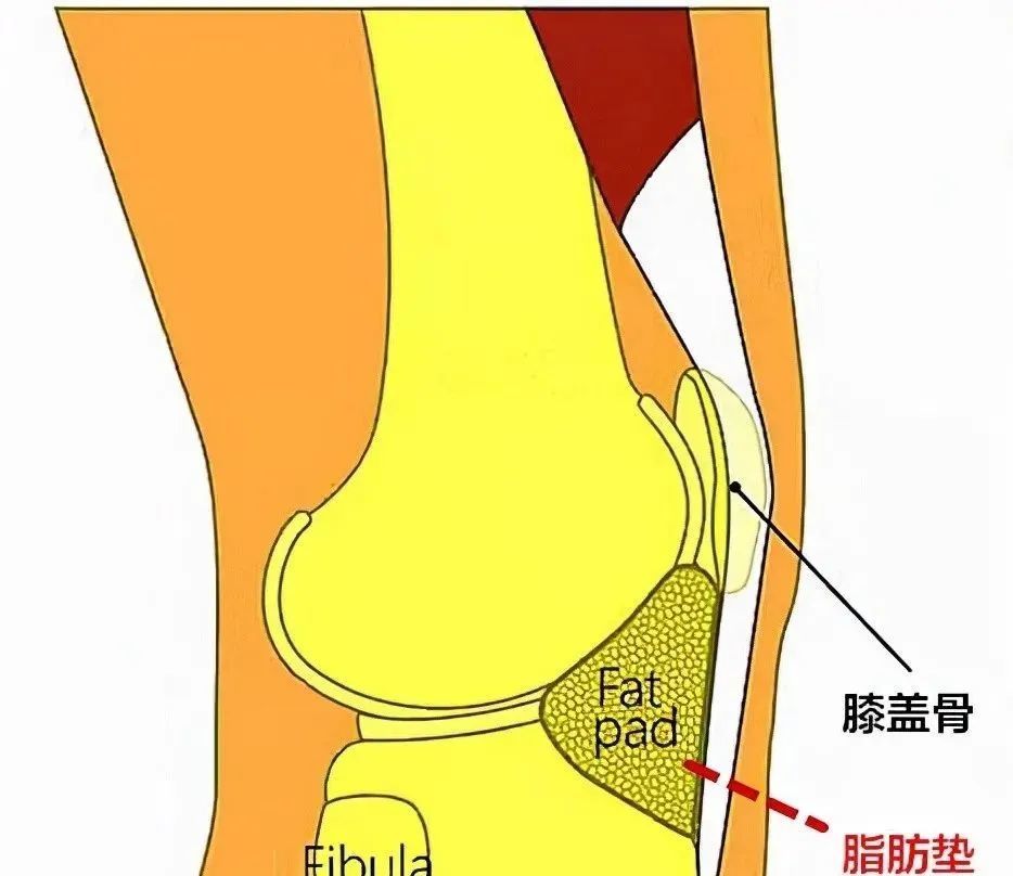 此位置有一个非常重要的髌下脂肪垫,是膝关节内滑膜外的一个特殊脂肪