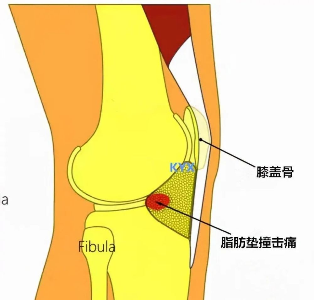 它会随着膝关节屈伸运动而移动,有向关节冲入的动态改变;在脂肪垫内有