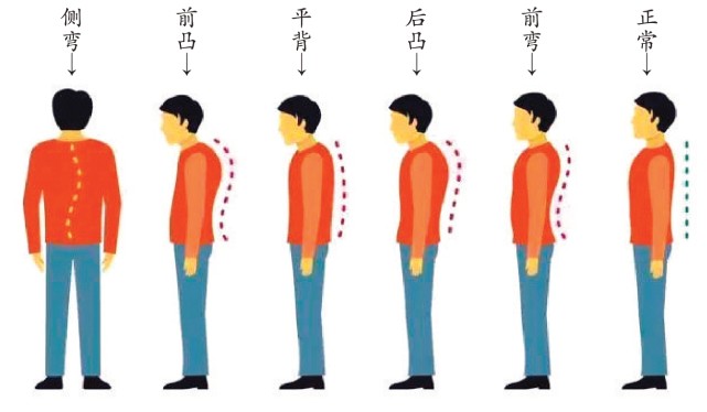 脊柱弯曲矫正基本原则是伸展脊柱,使脊柱经常向变形的相反方向弯曲