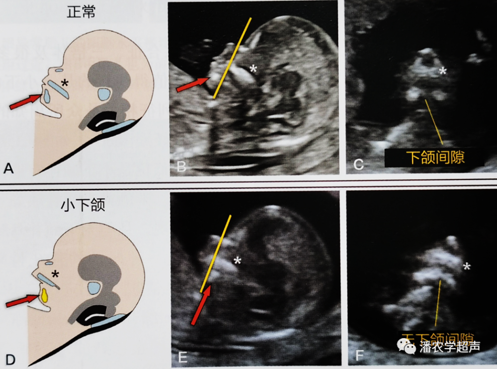孕12周13三体综合征小下颌(箭标指小且后缩的下颌)及nt增厚)开放性
