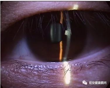 裂隙灯检查