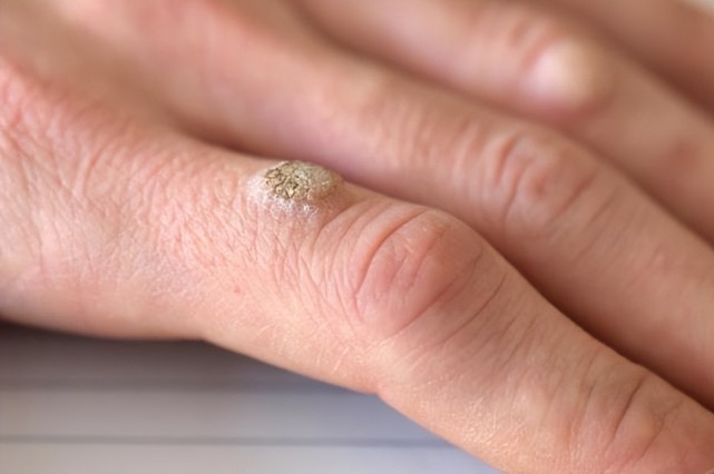男人身上长有这种"小揪揪,不是过敏,或是hpv"搞的鬼,多观察