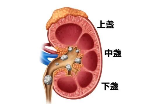 有时候急诊会见到这一幕有一定效果跳跃和倒立对于排出肾结石有一点用