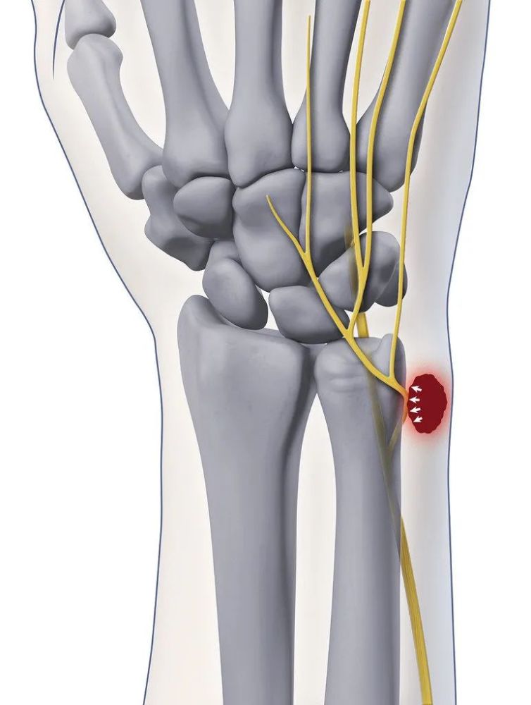 手腕尺侧疼痛的神经