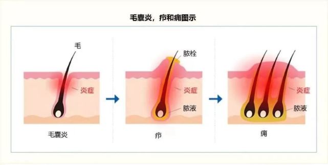 疖肿是人体皮肤单个毛囊或皮脂腺发生的急性化脓性感染,常由皮肤扩展