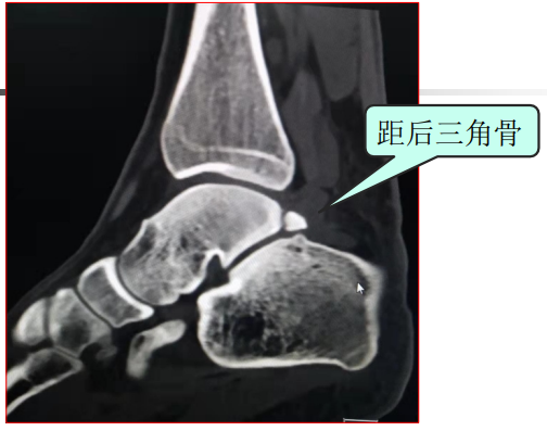 女性8-10岁,距骨后内侧结节和后外侧结节出现第二骨化中心,并在一年