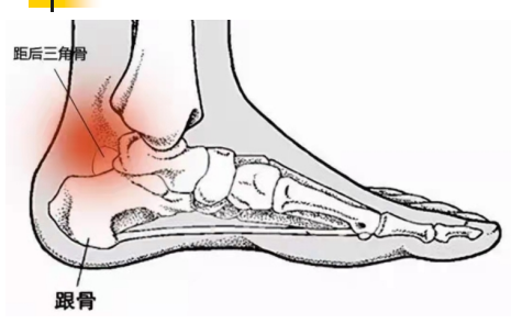 骨科精读|踝关节后方疼痛,当心距后三角骨损伤找上门!