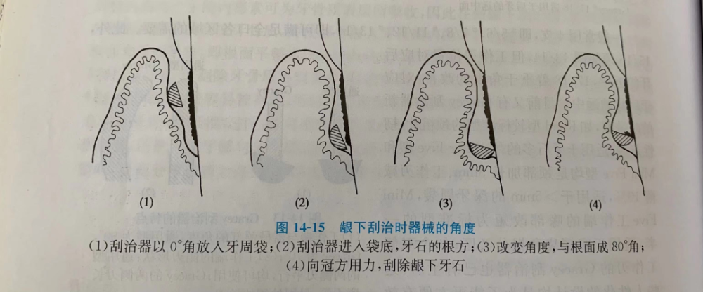 刮治完成后应仔细探查是否刮净,根面是否刮平刮光;5,在刮除深牙周袋中