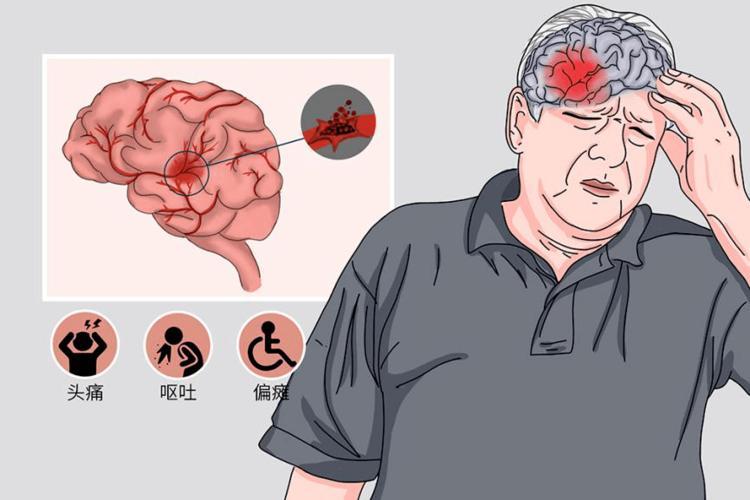 如何预防高血压发展为脑梗死脑出血记住这6点值得收藏