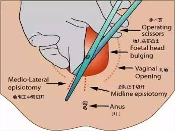 侧切就是分娩过程中,为了扩大产道出口,减少会阴撕裂,会在会阴联合