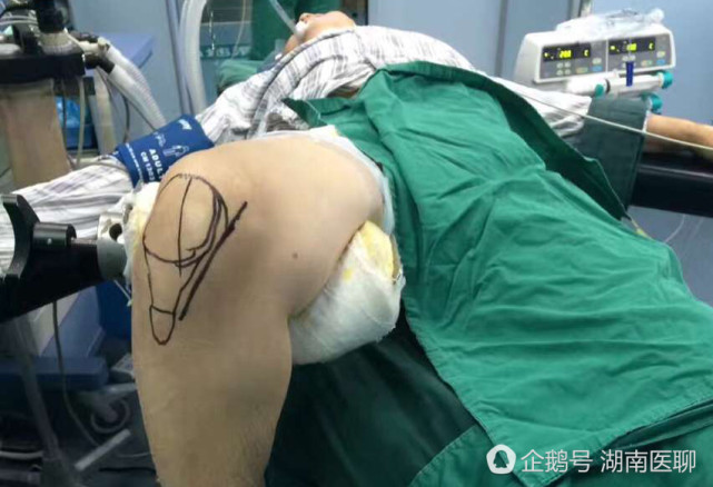 永州六旬老农膝关节疼痛 致畸形跛行6年