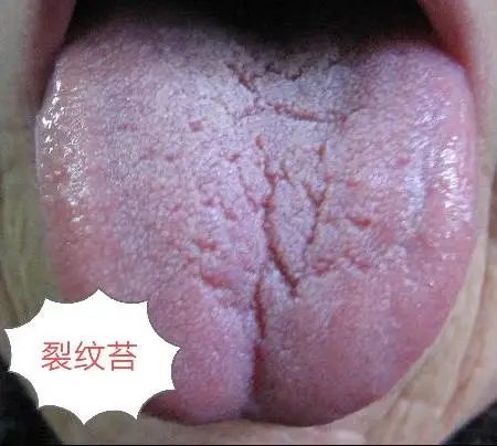 当舌苔出现这3种特征体内的湿寒郁结就重了