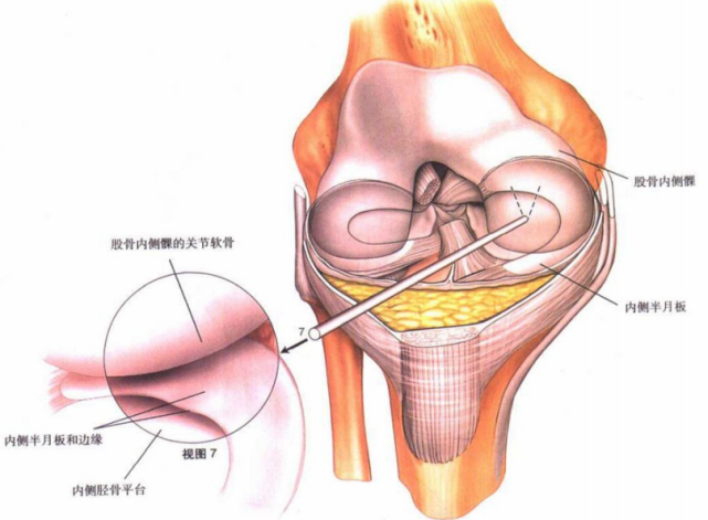 观察内侧股骨髁和内侧胫骨平台的关节软骨,同时也观察内侧半月板和