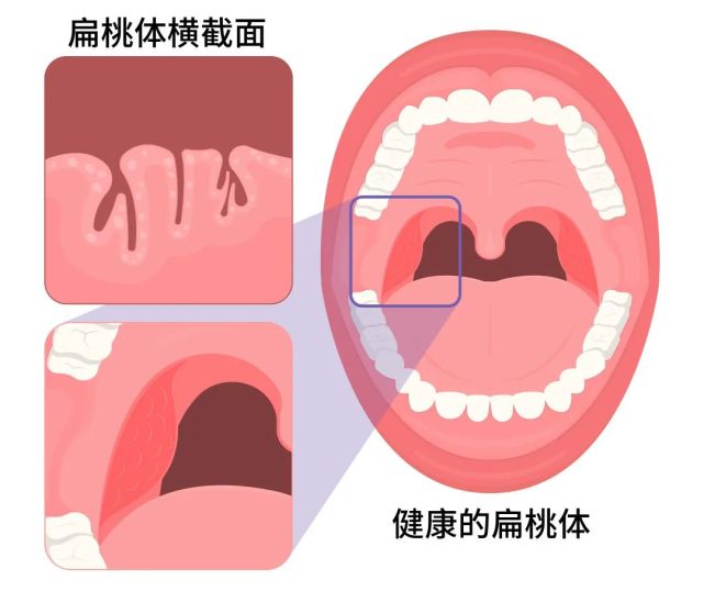 扁桃体的表面凹凸不平,像月球表面,它有很多褶皱,缝隙,形成扁桃体隐窝